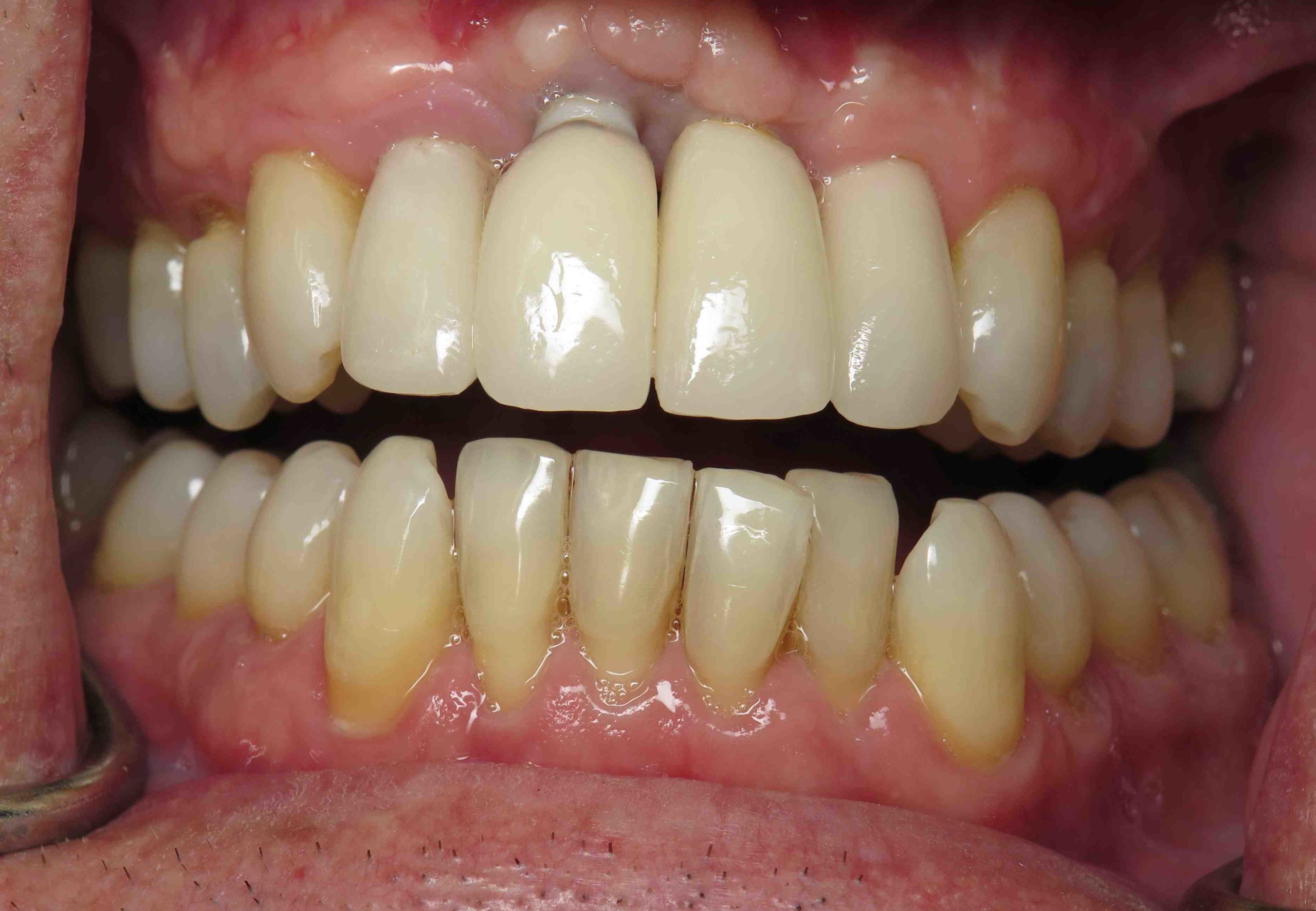 Can you have dental implants if you grind your teeth? Dental News Network