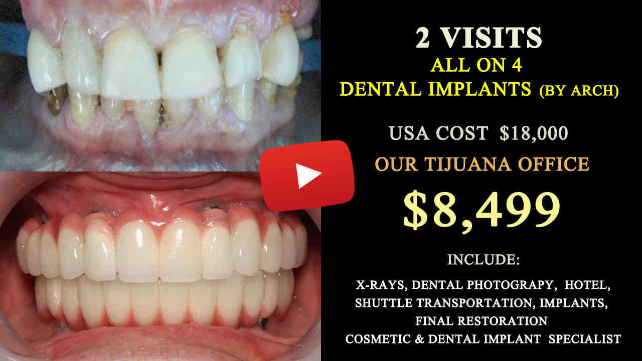How much does it cost to get a full mouth of dental implants in Canada?