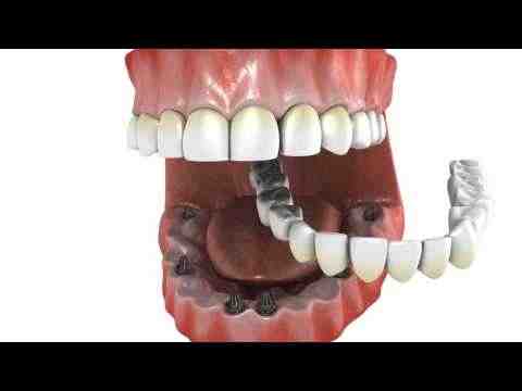 How much does it cost to replace all teeth with implants?