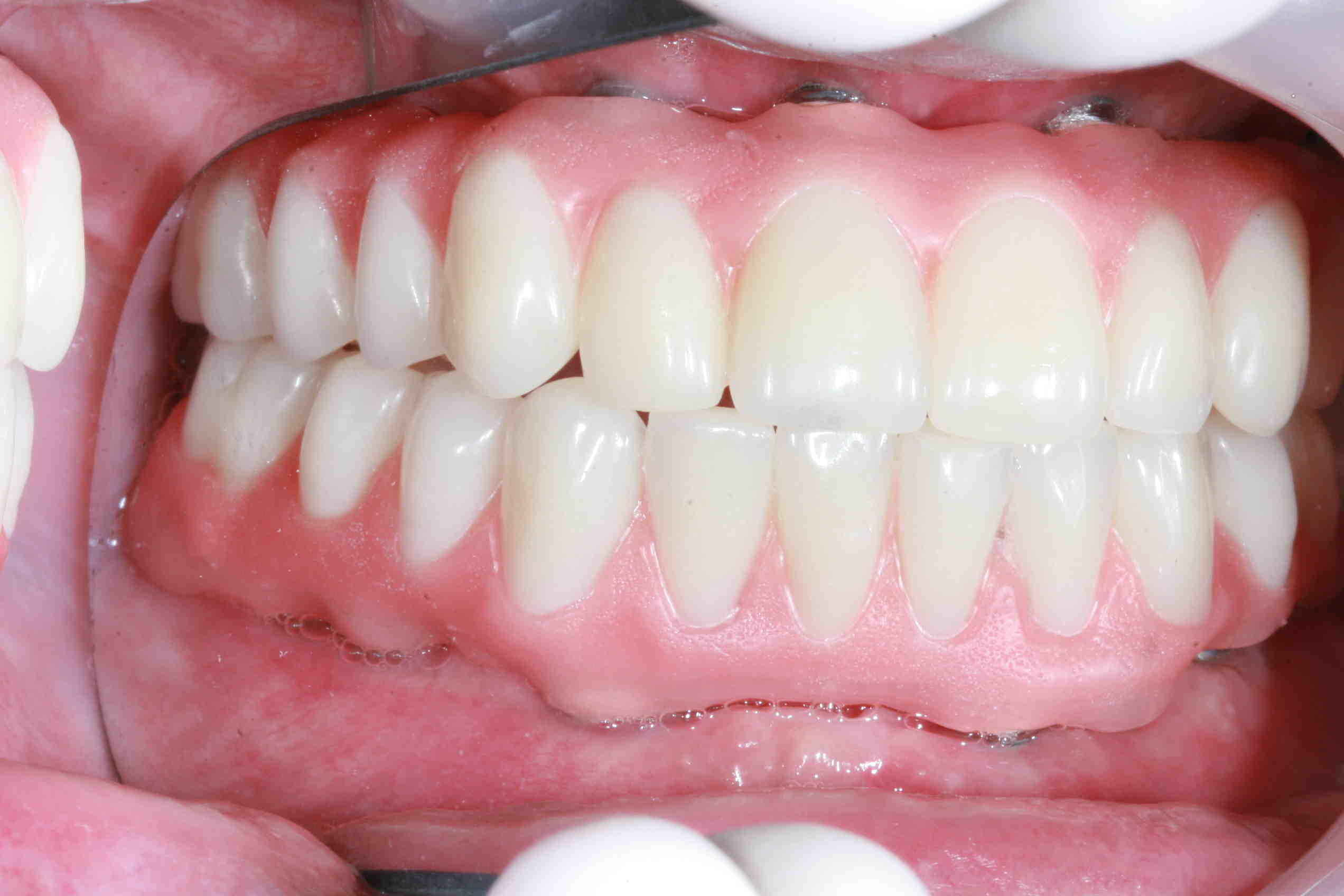 How much does it cost to replace all your teeth?