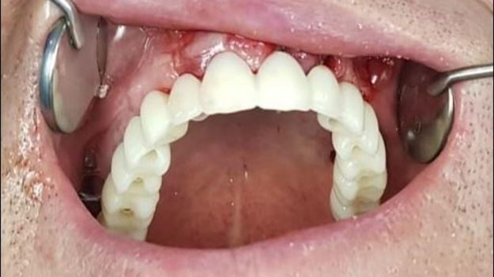 How much does it cost to replace all your teeth with implants?