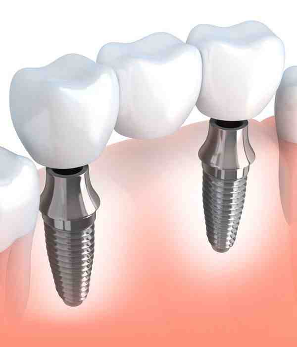 How much does it cost to veneer all your teeth?