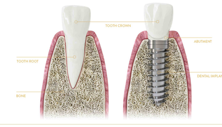 How much for dental implants per tooth