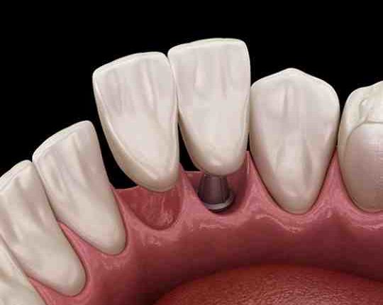 How much is 2 dental implants