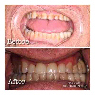 How much is a cosmetic filling?
