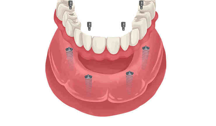 How much is a dental implant at a dental school?