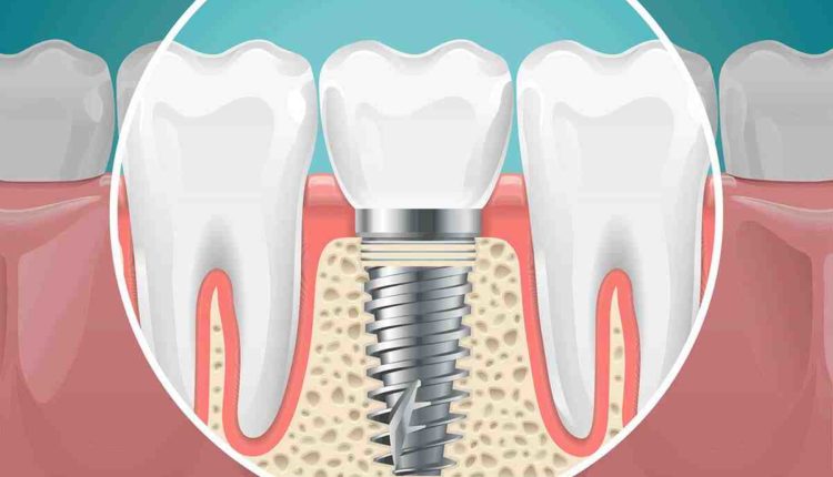How much is a dental implant cost