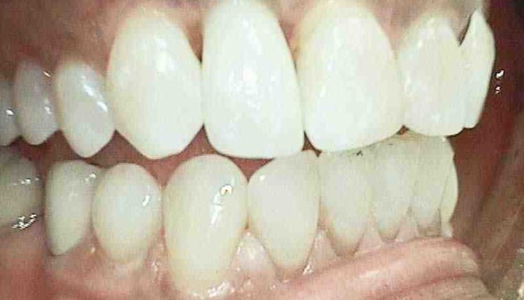 How much is a dental implant for one tooth