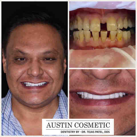 How much is a full mouth dental implants?