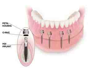 How much is a full set of mini dental implants?