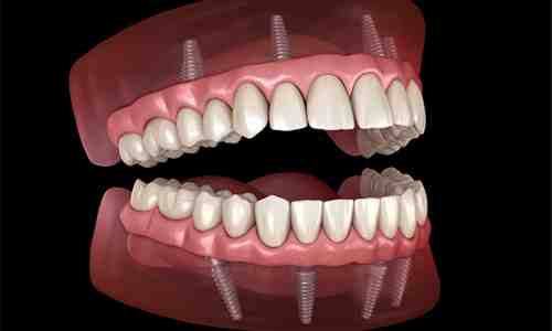 How much is a full top set of dental implants?
