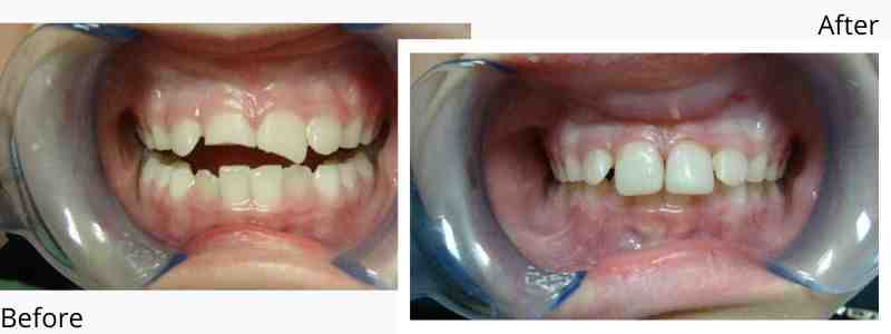 How much is a set of veneer teeth?