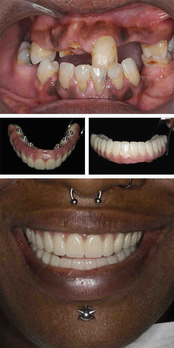How much should I pay for a dental implant?