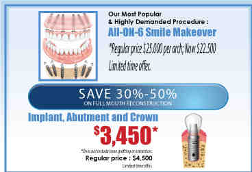 How much should dental implants cost in 2020?
