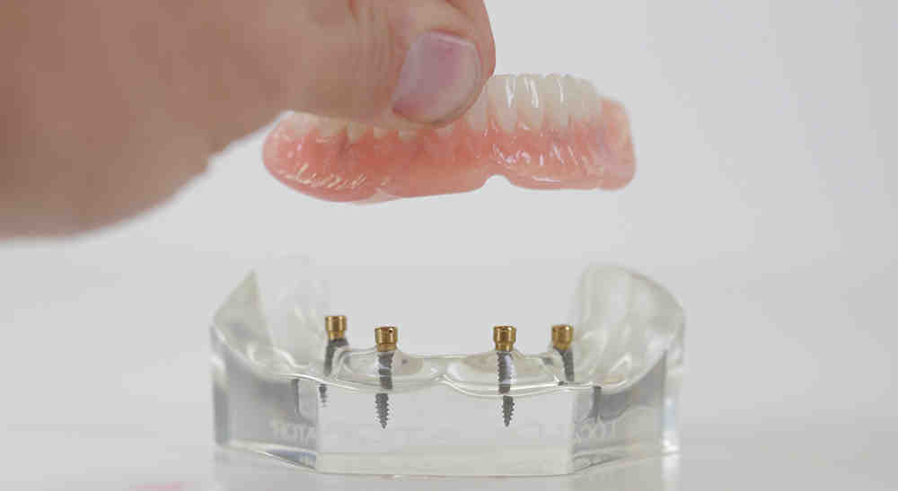 How much should dental implants cost in 2020?