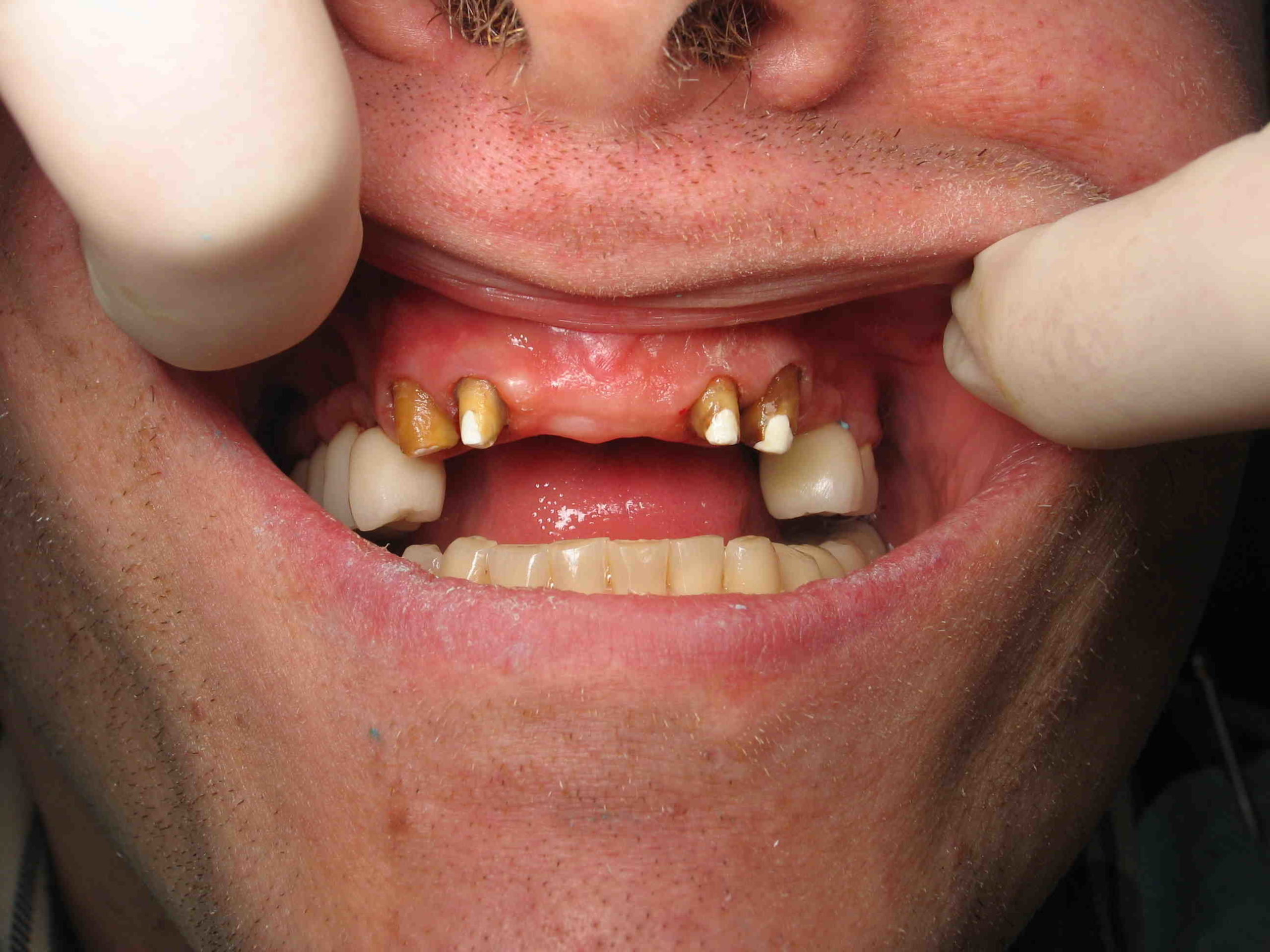 How much should dental implants cost in 2020?