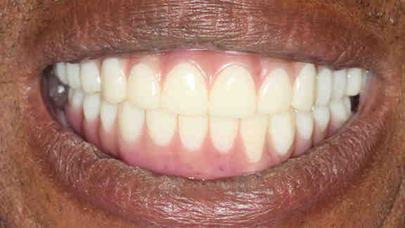 How much should dental implants cost in 2020?