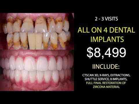 How much should implants cost per tooth?