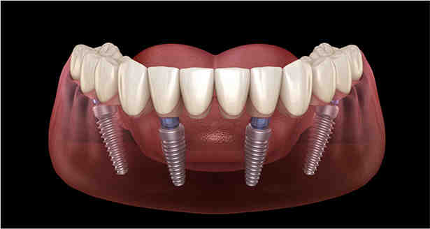 How much will dental implants cost in 2020?