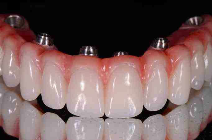 How much will dental implants cost in 2020?
