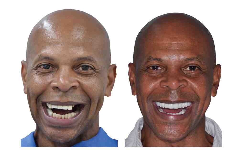 How much would all new teeth cost?