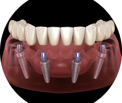 How much would full upper dental implants cost in spartanburg sc