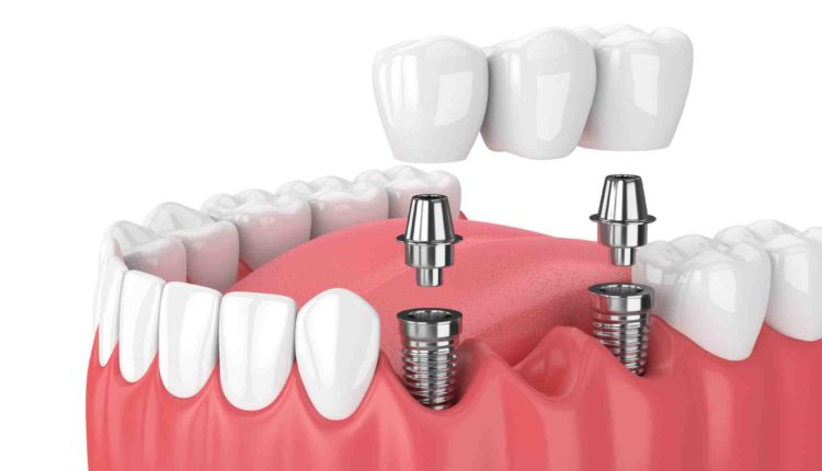 How painful are dental implants