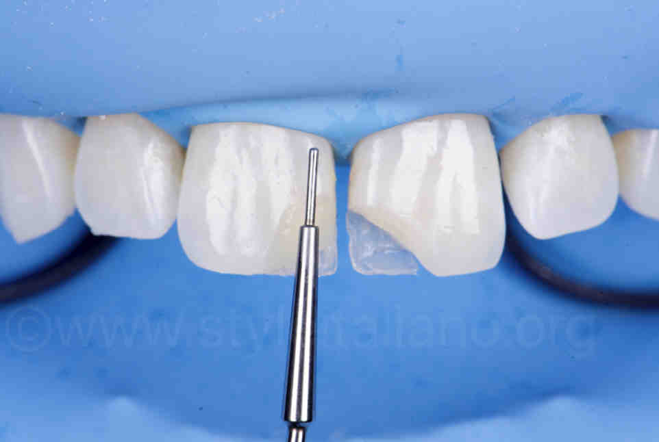 Cosmetic dentistry composite only Dental News Network