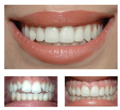Is composite bonding same as veneers?