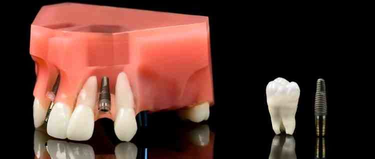 Is dental implant painful