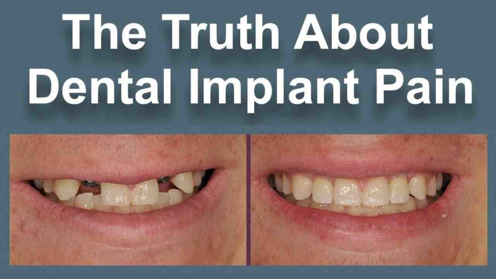 Is dental implant painful Dental News Network