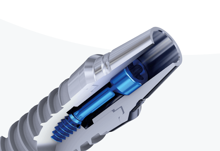 Does denti cal cover dental implants Dental News Network