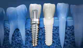 Is titanium safe for dental implants?