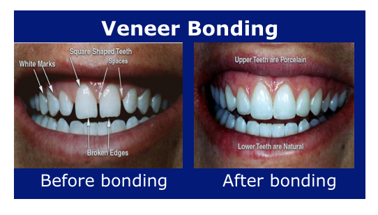 Should I get veneers or composite bonding?