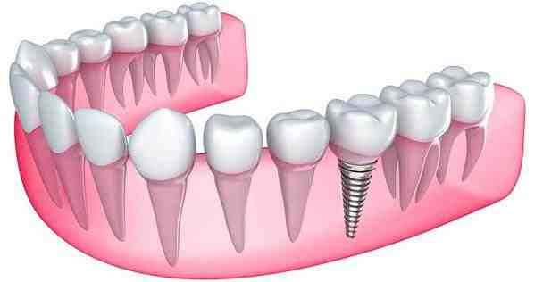 can-an-infected-dental-implant-be-saved-dental-news-network