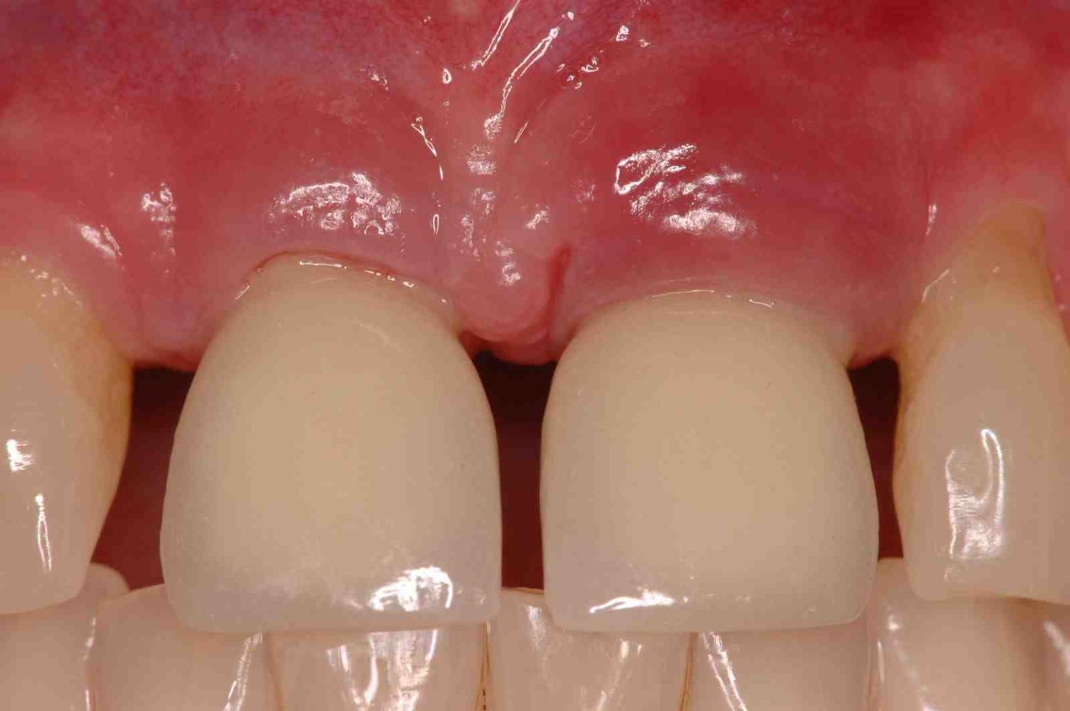 how-to-treat-infection-around-dental-implant-dental-news-network