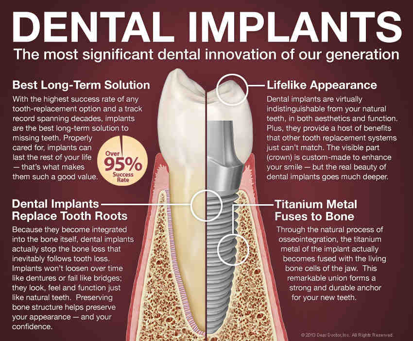 What is dental implants Dental News Network