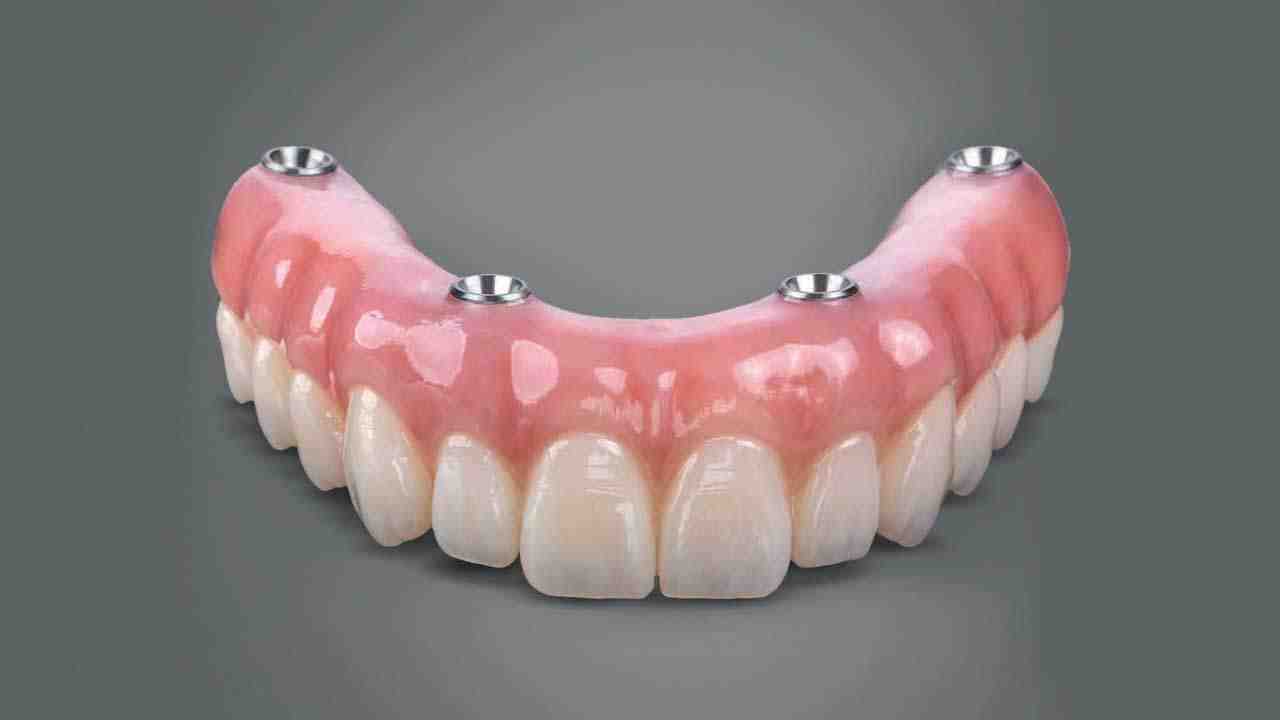 What are the disadvantages of dental implants?