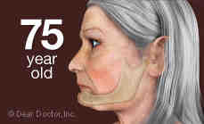 What are the negative effects of dental implants?