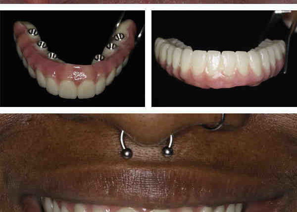 What are the negative effects of dental implants?