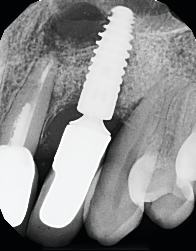 What are the signs of dental implant failure?