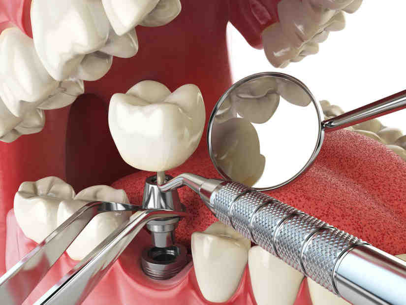 What are the steps for a dental implant?