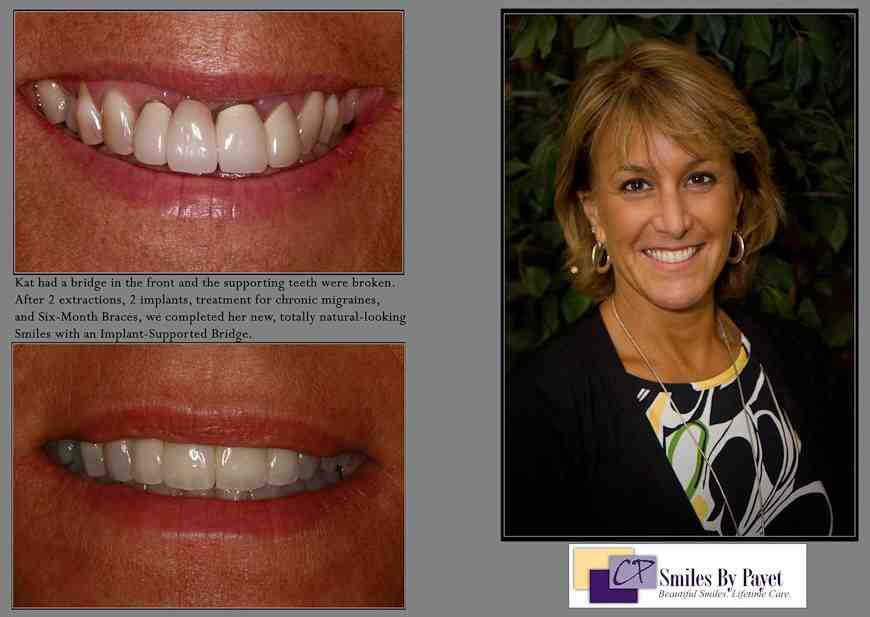 What can you not do after dental implants?