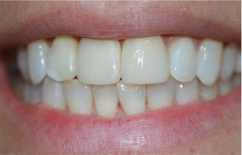 What dental implants should cost in 2020?
