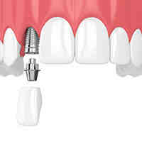 What dental insurance covers dental implants?