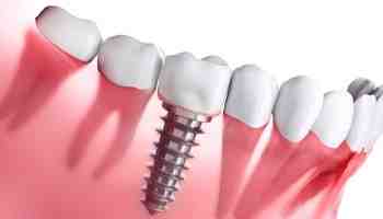 What does VA dental cover?