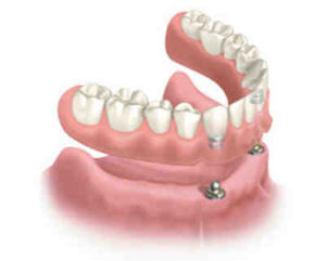wellcare dental does implants