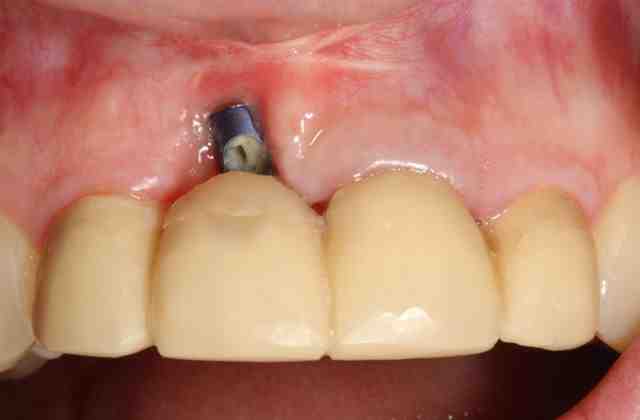What happens if a dental implant fails?