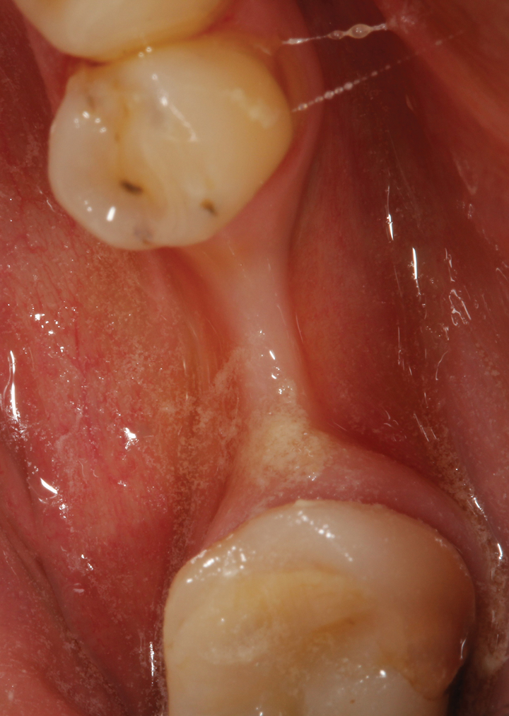 How to treat infection around dental implant Dental News Network