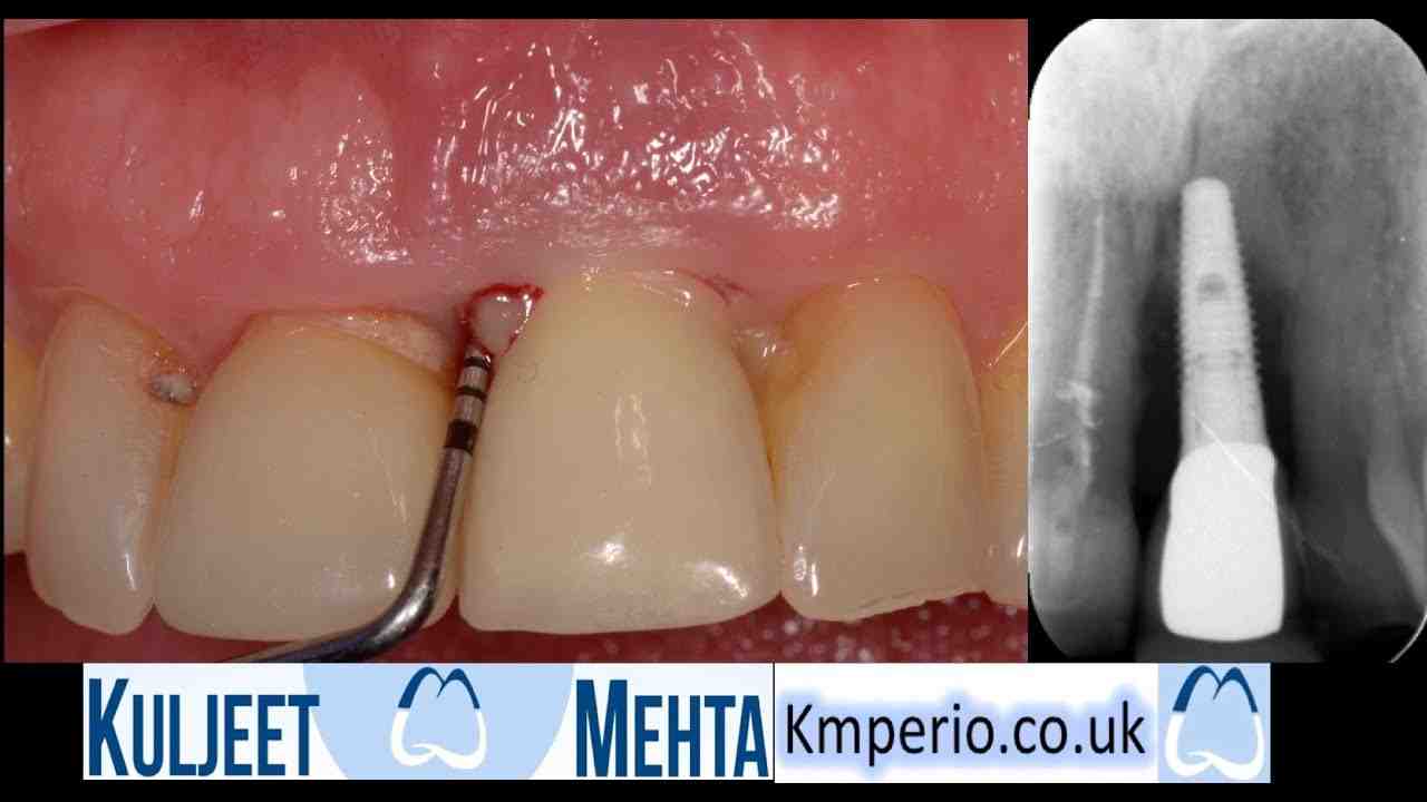 What happens if a tooth implant fails?